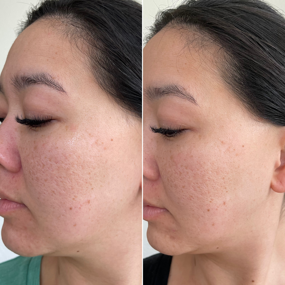 Before and after CurrentBody LED mask