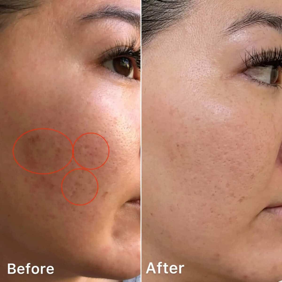 Non-invasive beauty treatments, by beauty blogger What The Fab